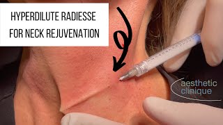 Hyperdilute Radiesse Calcium Hydroxyapatite For Neck Rejuvenation  triNECKta [upl. by Glynnis805]