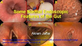 Some normal endoscopic features of the gut [upl. by Sirhc]