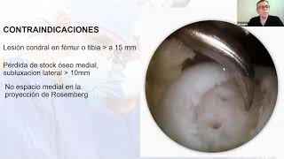 Webinar Osteotomía tibial alta [upl. by Nivag]