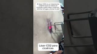 laser CO2 para cicatrices [upl. by Aisat949]