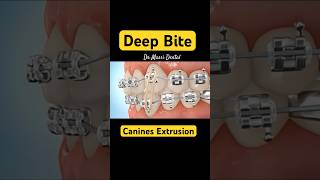 CANINE EXTRUSION Braces  Orthodontics treatments [upl. by Zetniuq]