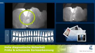 KaVo DIAGNOcam Strahlungsfreie Kariesdiagnostik [upl. by Wendi]