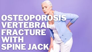 Osteoporosis Lumbar Vertebral Spine Compression Fracture causing back Pain Spine Jack Kyphoplasty [upl. by Flatto]