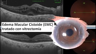 Edema Macular Cistoide EMC  Edema Macular Quístico  Vitrectomía  IrvineGass Syndrome [upl. by Ursas]