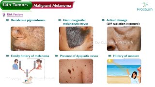 Malignant Melanoma Risk factors Types Characteristic features Diagnosis Surgery [upl. by Kuster]