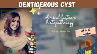 dentigerous cyst lecture I dental lectures [upl. by Enialahs]