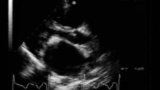 MS different aspectscalcified mitral stenosis [upl. by Aznola790]