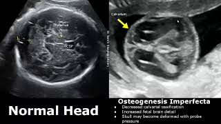 Fetal Musculoskeletal Ultrasound Normal Vs Abnormal Image Appearances  Skeletal Dysplasias MSK USG [upl. by Dorkus]