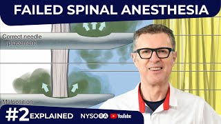 Failed Spinal Anesthesia Explained 2 Regional anesthesia Crash course with Dr Hadzic [upl. by Eigram]