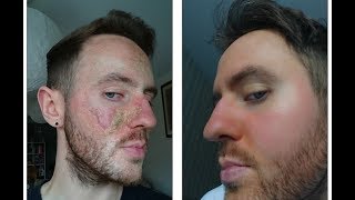 How Matt Healed his Eczema and Overcame Topical Steroid Withdrawal [upl. by Sedberry]