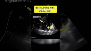 InterAtrial septal Aneurysm on Echocardiography echo heart [upl. by Htaek]