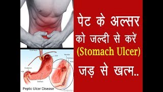 पेट के अल्सर को करें जड़ से ख़त्म Peptic Ulcer Treatment at Home [upl. by Atiugram]