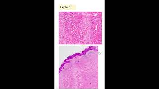 ShortsExam slideselongated cells keloidleiomyoma hyaline change Dr GSS SRM MCH RC [upl. by Bilak361]