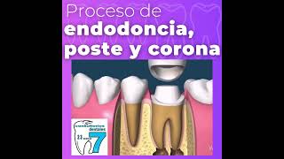 proceso de endodoncia [upl. by Liw]