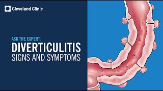 Warning Signs of Diverticulitis  Ask Cleveland Clinics Expert [upl. by Barnum]