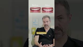 Why Composite Bonding Is The Safest Smile Upgrade 😮‍💨🦷✨ dentist cosmeticdentistry [upl. by Dag]