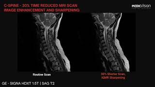 Cspine  30 time reduced MRI scan iQMR Image Enhancement and Sharpening [upl. by Daph]