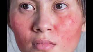 Beauty Tips Series Vol 2 9 Possible side effects of oral Isotretinoin in managing Acne [upl. by Ennovy912]