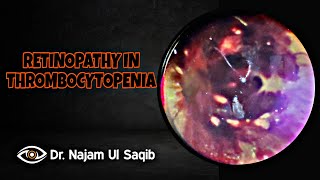 Retinopathy In Thrombocytopenia Indirect Ophthalmoscopy [upl. by Nylinnej403]