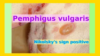 pemphigus vulgaris [upl. by Chaddy]