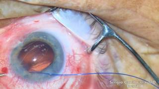 New management for Subluxated Cataract  Double Flanged CTS fixation  Canabrava Technique [upl. by Dammahum12]