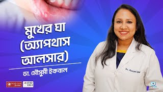 মুখের ঘা অ্যাপথাস আলসার Aphthous ulcer treatment bangla [upl. by Ahsinot]