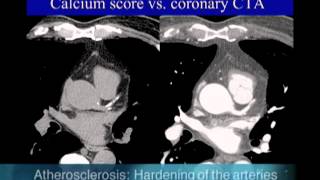 UCSF Radiology Calcium Scoring vs Coronary CTA Scan [upl. by Anesuza]