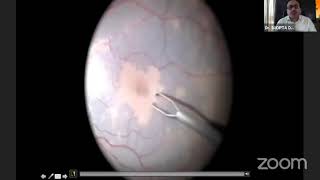 AIOC2021GP35TopicDrSUDIPTA DAS Surgical tips in Lamellar hole related epiretinal proliferation [upl. by Doone]