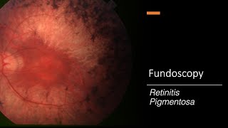 Retinitis Pigmentosa Fundoscopy [upl. by Harikahs]