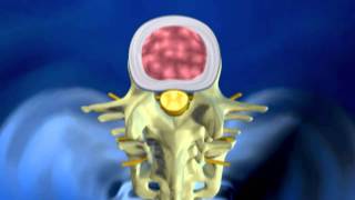 Herniated Disc Explanation [upl. by Brig]