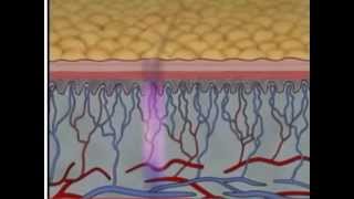 Phases of Wound Healing Pt 2  Wound Care Management  WoundEducatorscom [upl. by Enilatan]