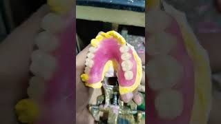 Acrylic Removable Partial Denture By Haider [upl. by Oleg]