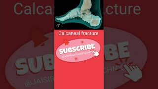 Calcaneal fracture anatomy orthopedics short [upl. by Patt]