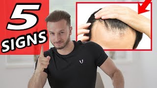 5 Early Signs of Balding  3 Tips to prevent it NOW [upl. by Tarrel]