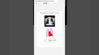 XRAY FINDINGS OF TETRALOGY OF FALLOT [upl. by Croft987]