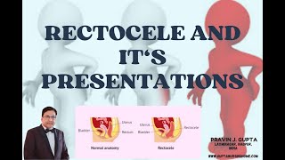 RECTOCELE VARIOUS SURGICAL OPTIONS FOR THIS TROUBLESOME DISEASE [upl. by Stroup524]