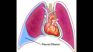 Pleural Effusion Lights Criteria  USMLE STEP COMLEX NCLEX [upl. by Erodaeht]