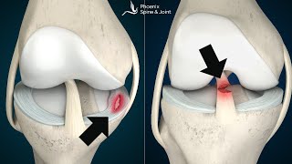 Is your knee pain coming from an ACL tear or Meniscus injury How to tell [upl. by Adiarf129]