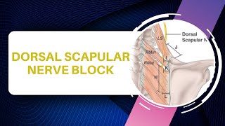 Dorsal Scapular Nerve Injection Technique [upl. by Odey300]