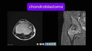 Chondroblastoma [upl. by Nord]