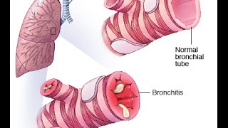 Bronchitis PEV [upl. by Ynogoham]