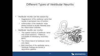 Otometrics Webinar  Vestibular Neuritis How to Identify Different Types [upl. by Yuht]