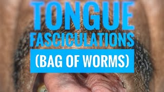 Tongue fasciculations quotBag of wormsquot  mbbs medicine neurology [upl. by Zeuqram]