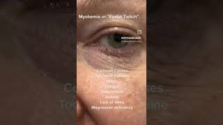 Myokymia or eyelid twitch youtubeshorts science medicalstudent shortsfeed biology [upl. by Niryt187]