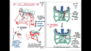 6 CSF Rhinorrhea [upl. by Akinot]