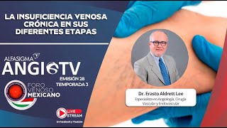 quotLA INSUFICIENCIA VENOSA CRÓNICA EN SUS DIFERENTES ETAPASquot  E28  T3  ANGIO TV [upl. by Ninos]