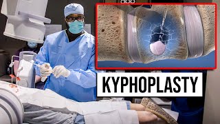 Kyphoplasty  Outpatient  Same Day Procedure for Vertebral Compression Fractures [upl. by Nnod]