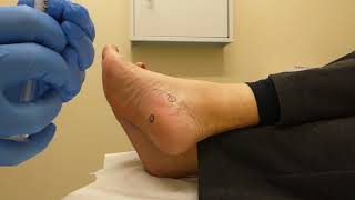 Injection  plantar fasciitis and tarsal tunnel syndrome  2 injections [upl. by Yrrol]