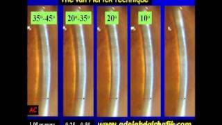 Gonioscopy Lecture part 08 [upl. by Ezalb]