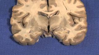 Hypothalamus Neuroanatomy Video Lab  Brain Dissections [upl. by Blight]